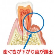 歯周病の進行（歯の露出）